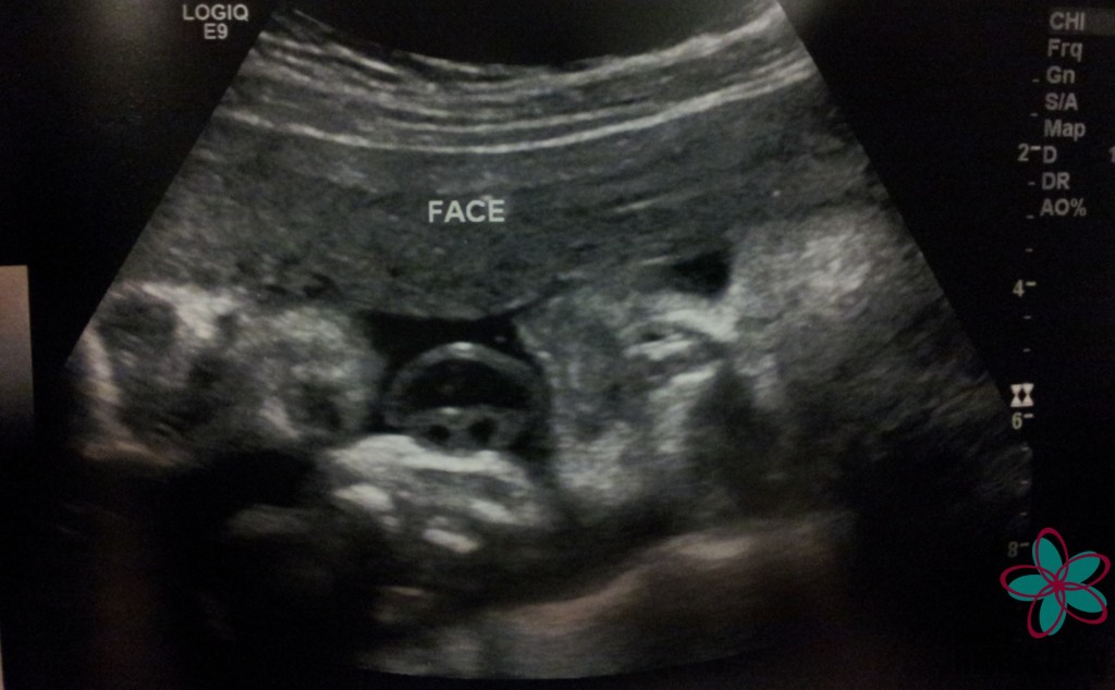 Preemie Ultrasound