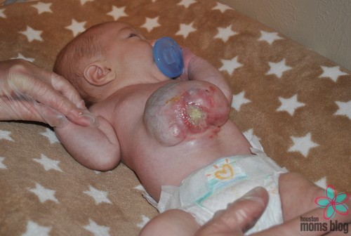 A baby with an omphalocele.