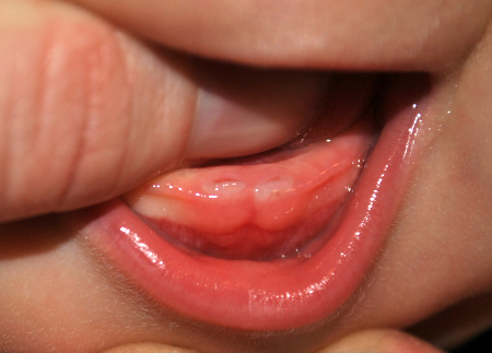 A person's thumb in a baby's mouth to show two bottom teeth. 