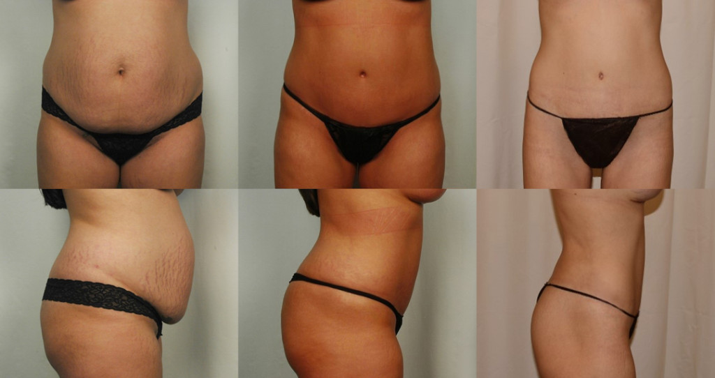 Two rows of photographs with three photographs each. The top row depicts the abdomen from the front. The bottom row depicts the abdomen from the side.  The photographs on the left both depict the lower belly with stretch marks and a paunch. The photographs in the middle depict a flatter stomach with no visible stretch marks. The photographs on the right depict an even flatter stomach. 