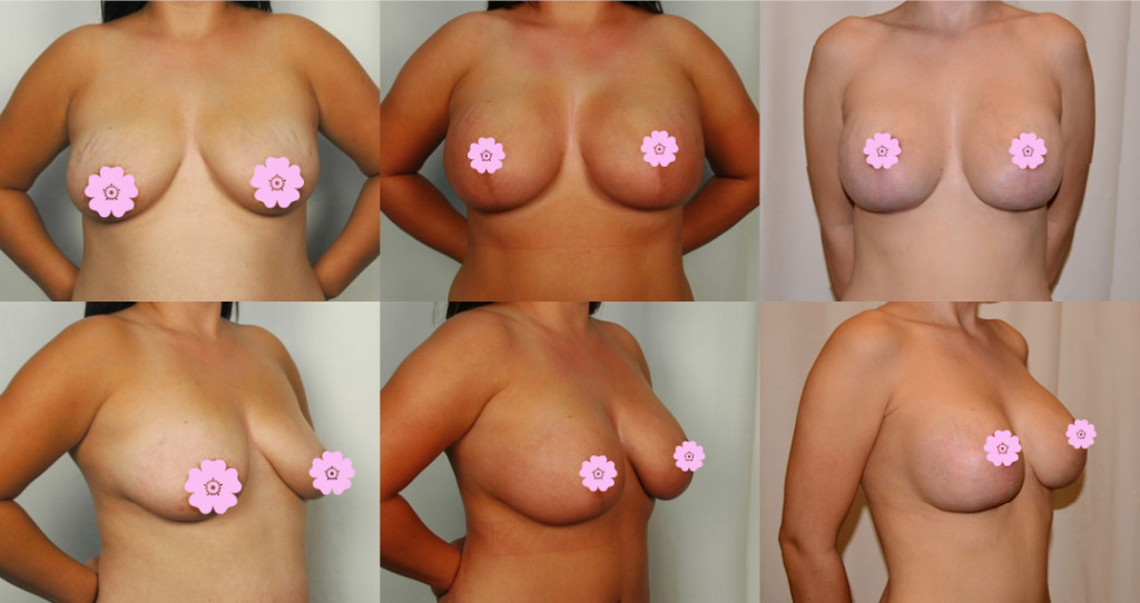 Two rows of photographs with three photographs each. The top row depicts breast augmentation from the front. The bottom row depicts breast augmentation from the side.  The photographs on the left both depict breasts that are lower. The photographs in the middle and on the right both depict breasts that are higher. 