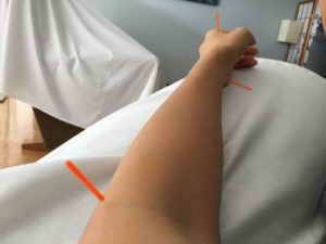 Anxiety and the Friendly Needles of Acupuncture | Houston Moms Blog